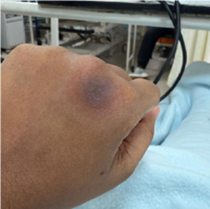 Fixed food eruption with multiple food triggers following suspected drug reaction