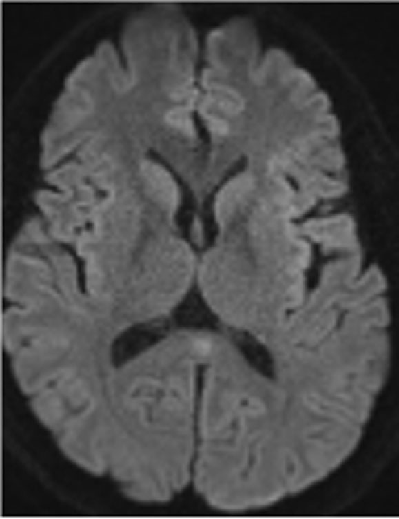 Adult-onset acute disseminated encephalomyelitis following severe Salmonella gastroenteritis